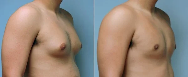 Non-Invasive Breast Reduction - USA Ultra Slim