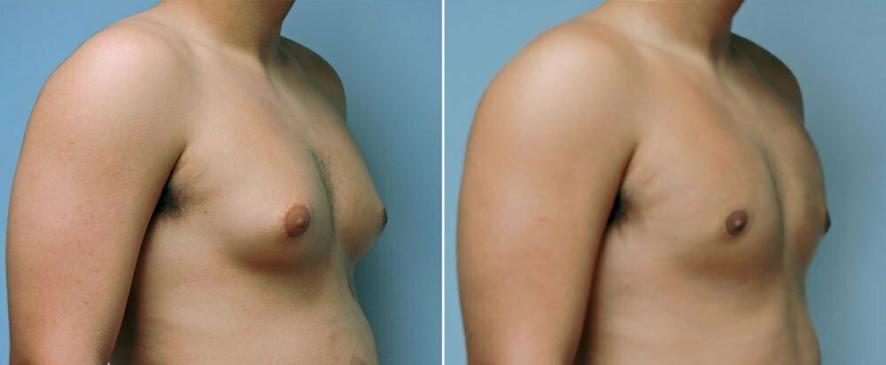 How to Shape Chest after Gynecomastia Surgery?