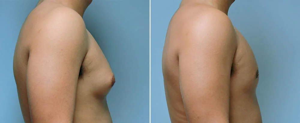 Can You Reduce Breast Size Without Surgery? - Donald Conway, MD, FACS