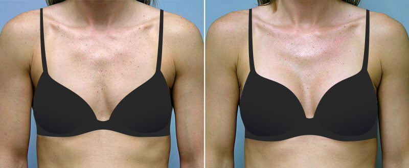 Before and after breast augmentation by Asheville plastic surgeon Dr. Donald Conway