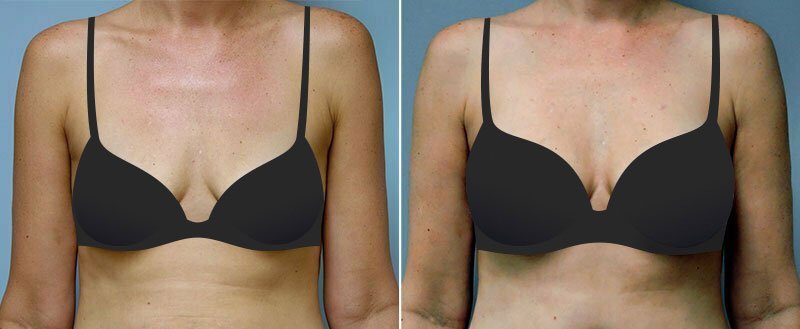 Before and after breast augmentation by Asheville plastic surgeon Dr. Donald Conway