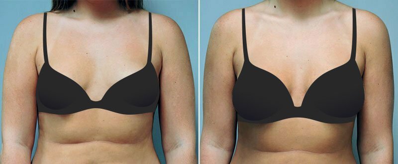 Before and after breast augmentation by Asheville plastic surgeon Dr. Donald Conway