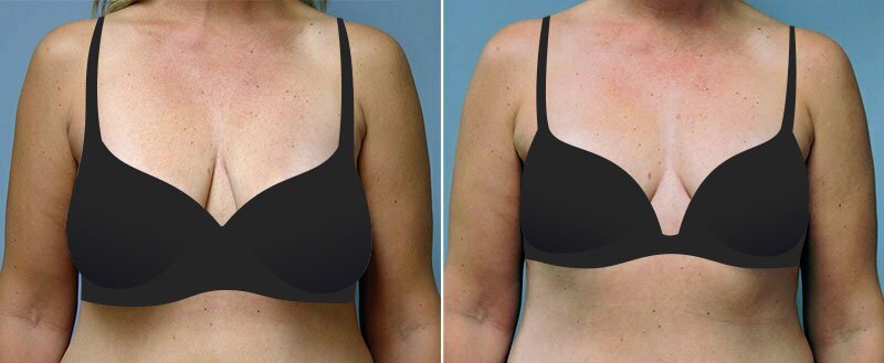 Before and after breast lift (mastopexy) surgery by Asheville plastic surgeon Dr. Donald Conway