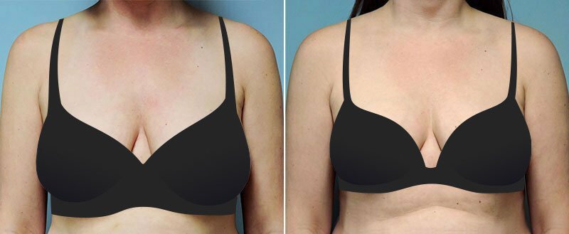 Woman shown before and after breast lift (mastopexy) surgery by Asheville plastic surgeon Dr. Donald Conway