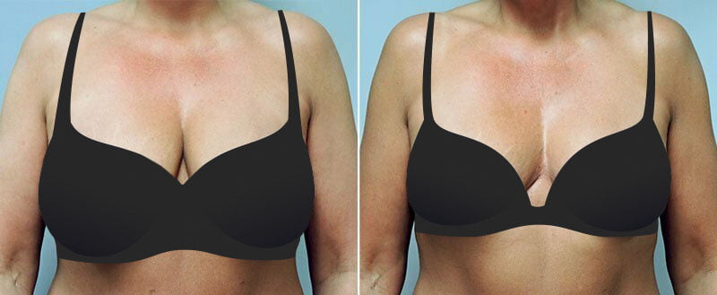 Female patient shown before and after breast lift (mastopexy) surgery by Asheville plastic surgeon Dr. Donald Conway