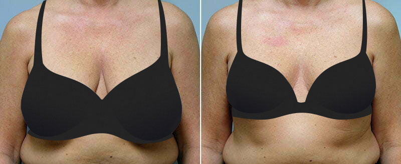 Patient shown before and after breast reduction by Asheville plastic surgeon Dr. Donald Conway