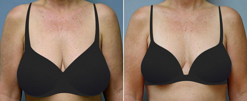 Before and after breast reduction surgery by Asheville plastic surgeon Dr. Donald Conway