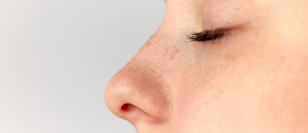 Woman with a refined button nose after rhinoplasty surgery