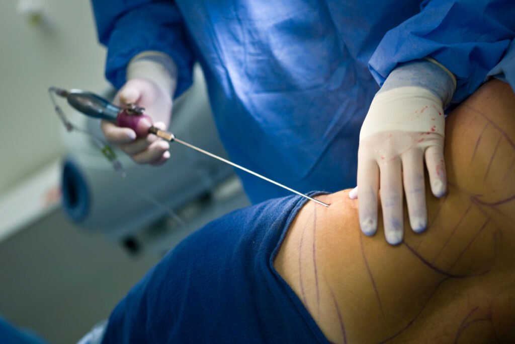 Plastic surgeon performing liposuction surgery